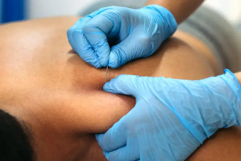 Physiotherapists performing intramuscular stimulation (IMS) with an acupuncture needle in a patient's trapezius muscle.