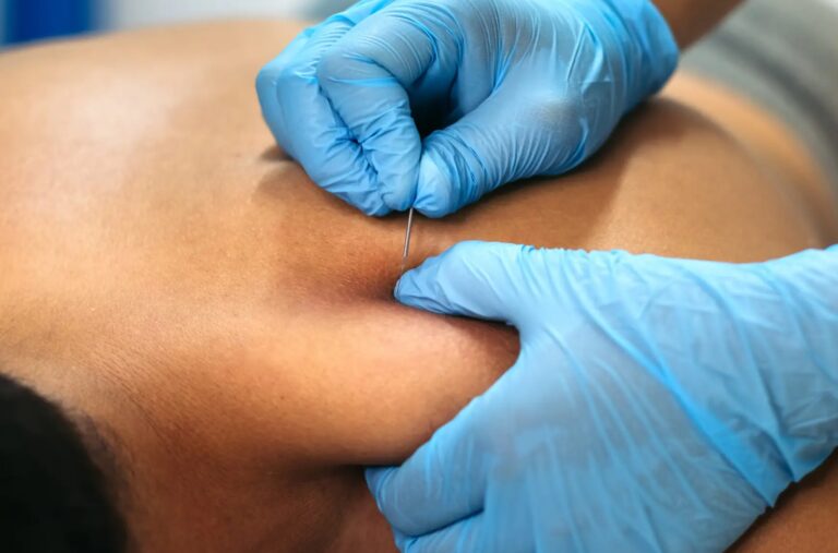 Physiotherapists performing intramuscular stimulation (IMS) with an acupuncture needle in a patient's trapezius muscle.