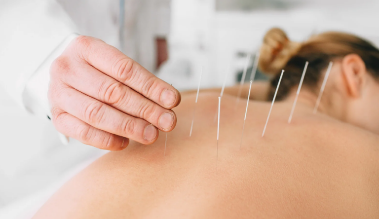 Licensed acupuncturist inserting needles into a patient's back at a Coquitlam clinic